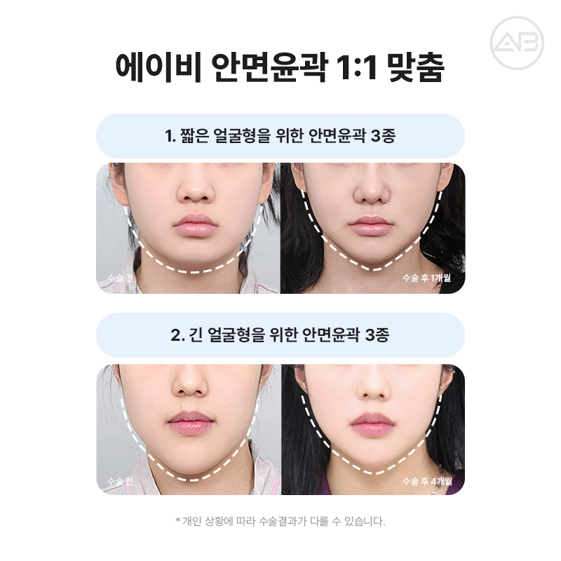 자연스럽고 조화로운 자려한안면윤곽을 원한다면 AB성형외과 관련 이미지 5