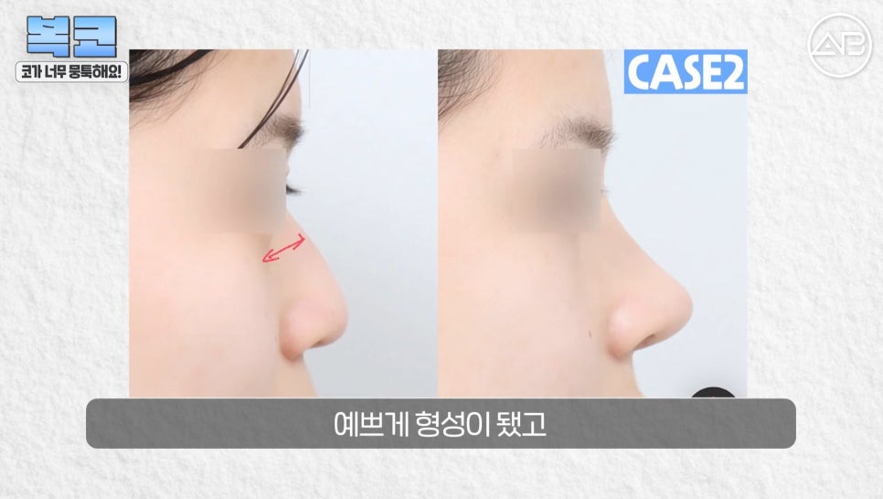 #에이비성형외과#에이비tv#코성형#복코성형 관련 이미지 19
