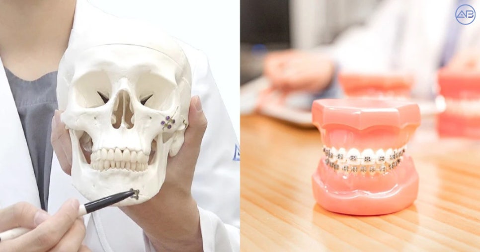 Which Should Be Done First: Facial Contouring Surgery or Orthodontic Treatment? image 1