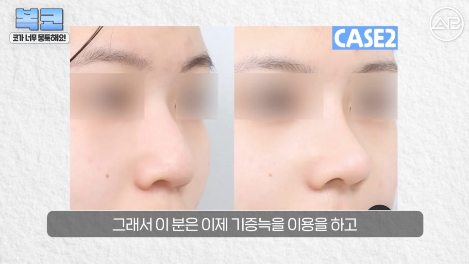 #에이비성형외과#에이비tv#코성형#복코성형 관련 이미지 18