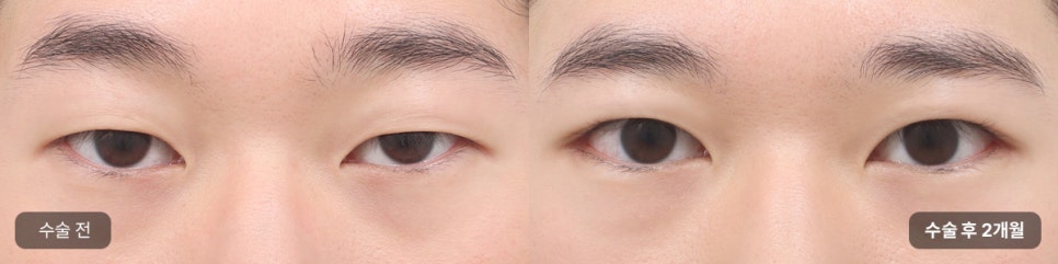 Key Points of Male Eye Surgery, Explained by AB! (Feat. Director Son Ji-hwan) image 5