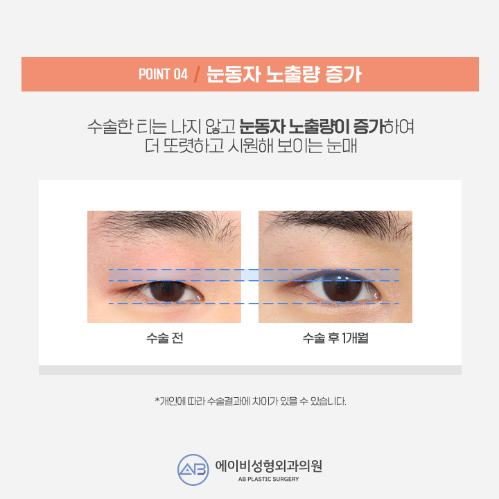 남자눈성형잘하는곳 에이비 라며? 관련 이미지 5