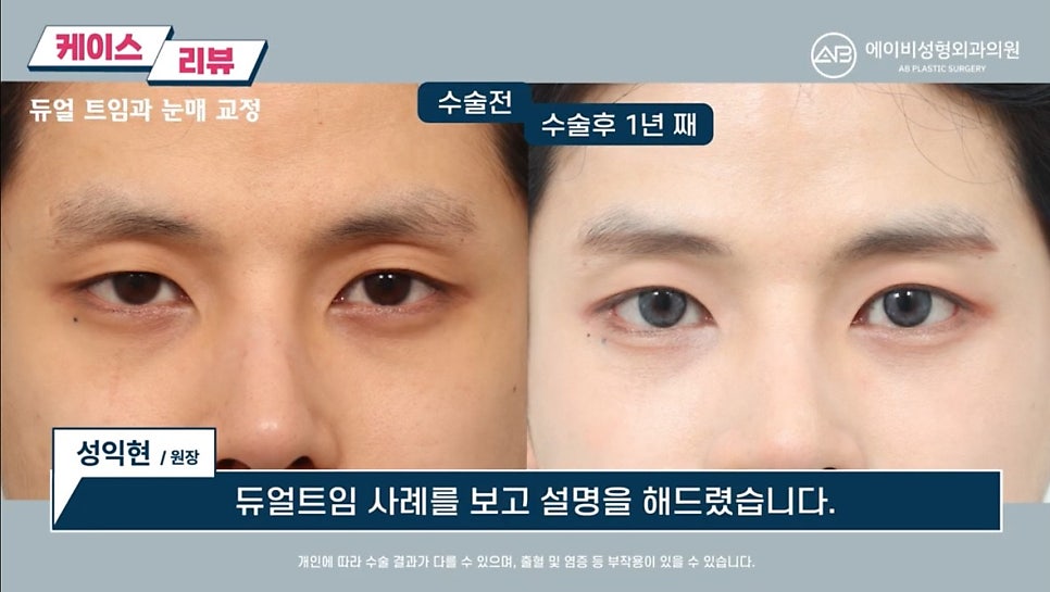 #에이비성형외과#에이비tv#눈성형#남자눈성형 관련 이미지 9