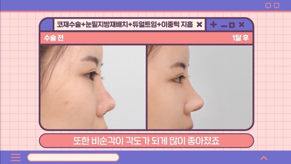 #AB Plastic Surgery #AB TV ##Case Review #Eye Surgery #Nose Revision Surgery image 7