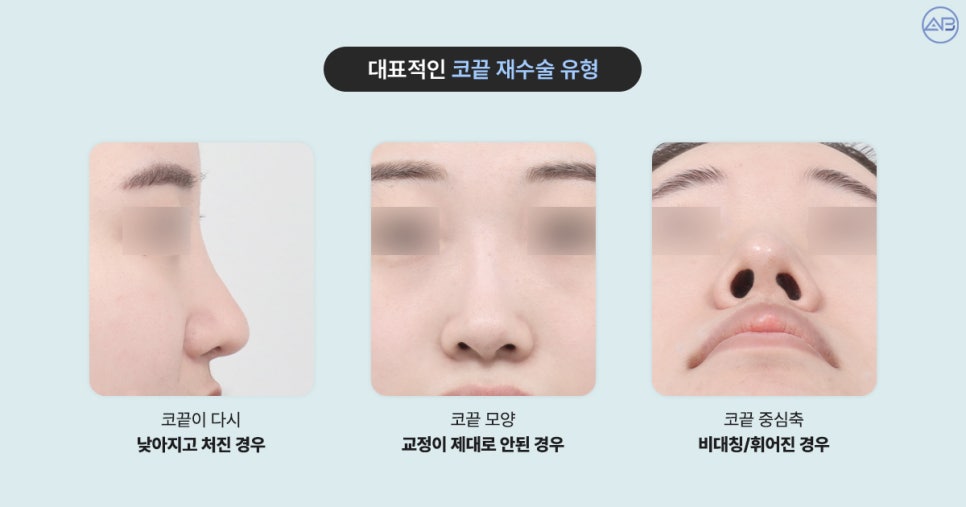 코끝이 낮아지거나 뭉툭해졌다면? 에이비성형외과 코끝 재수술로 바로잡기 관련 이미지 2