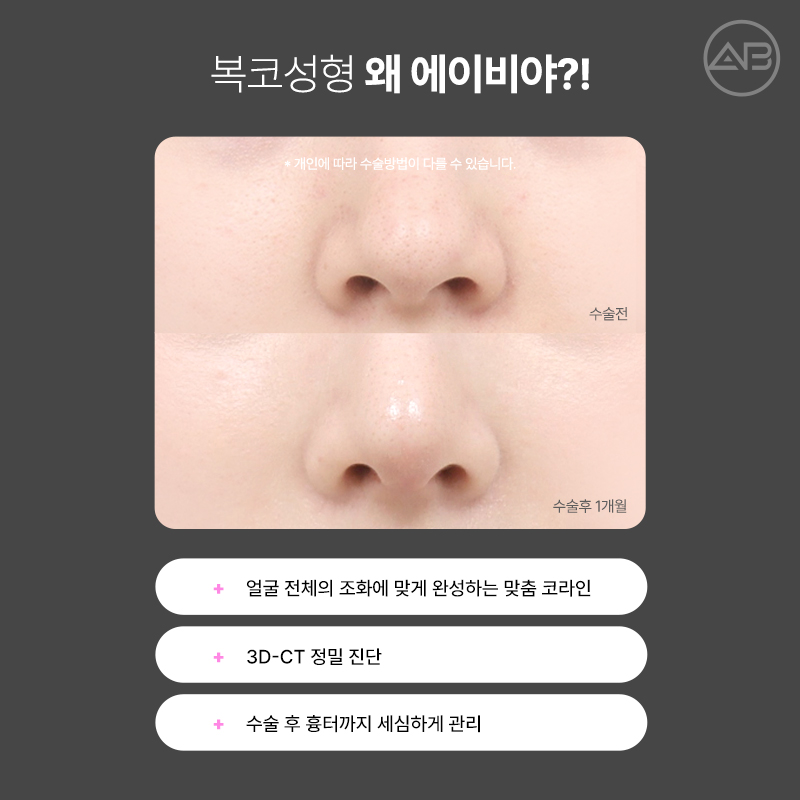 Why AB Plastic Surgery Is Famous for Bulbous Nose Surgery image 6