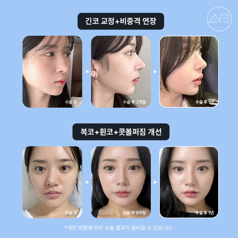 코재수술 필요하다면 에이비성형외과 관련 이미지 13