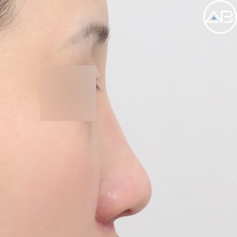 AB Plastic Surgery Low Nose Rhinoplasty Case Review (Feat. Director Seo Chan-eol) image 2