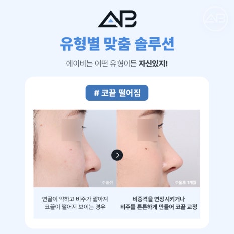 코재수술 필요하다면 에이비성형외과 관련 이미지 2