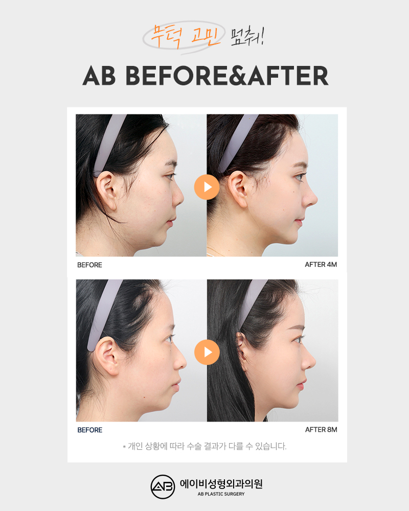 AB Plastic Surgery with Many Facial Contouring Reviews image 4
