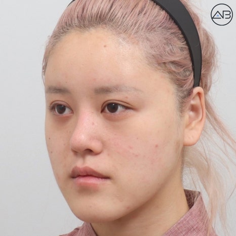 에이비성형외과 양악+윤곽수술(사각턱 턱끝) 케이스 리뷰 관련 이미지 5