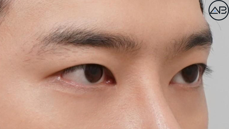 AB Plastic Surgery Men’s Eye Surgery - First Snow Case Review image 4