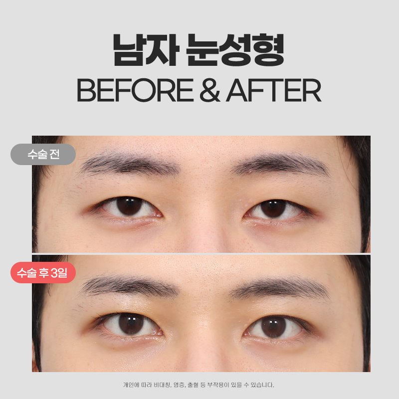 [칼럼] 쌍꺼풀 없이, 눈매교정만 할 수는 없나요? 관련 이미지 3