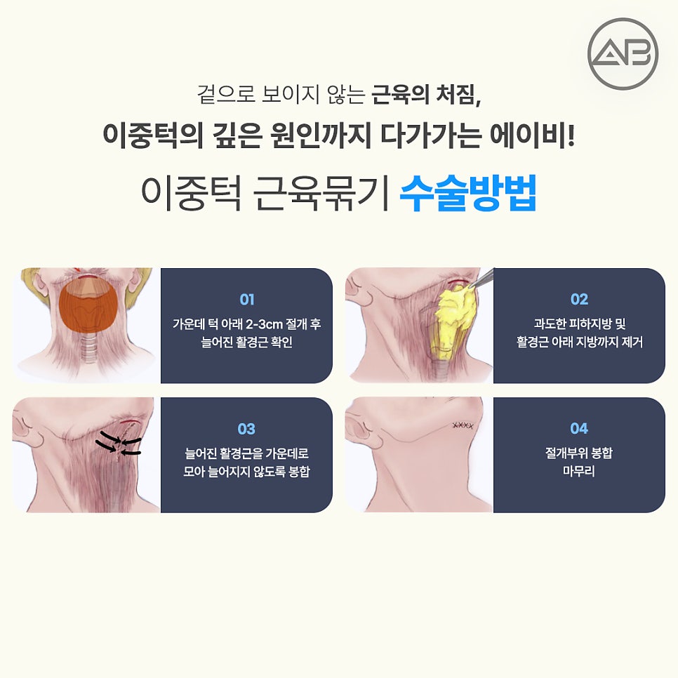 The Secret to a Slim Jawline, AB Plastic Surgery Double Chin Muscle Binding image 14