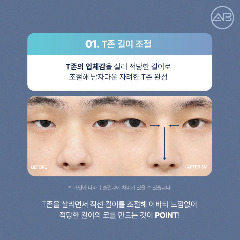 자려한직선코성형은 역시 에이비성형외과 관련 이미지 7
