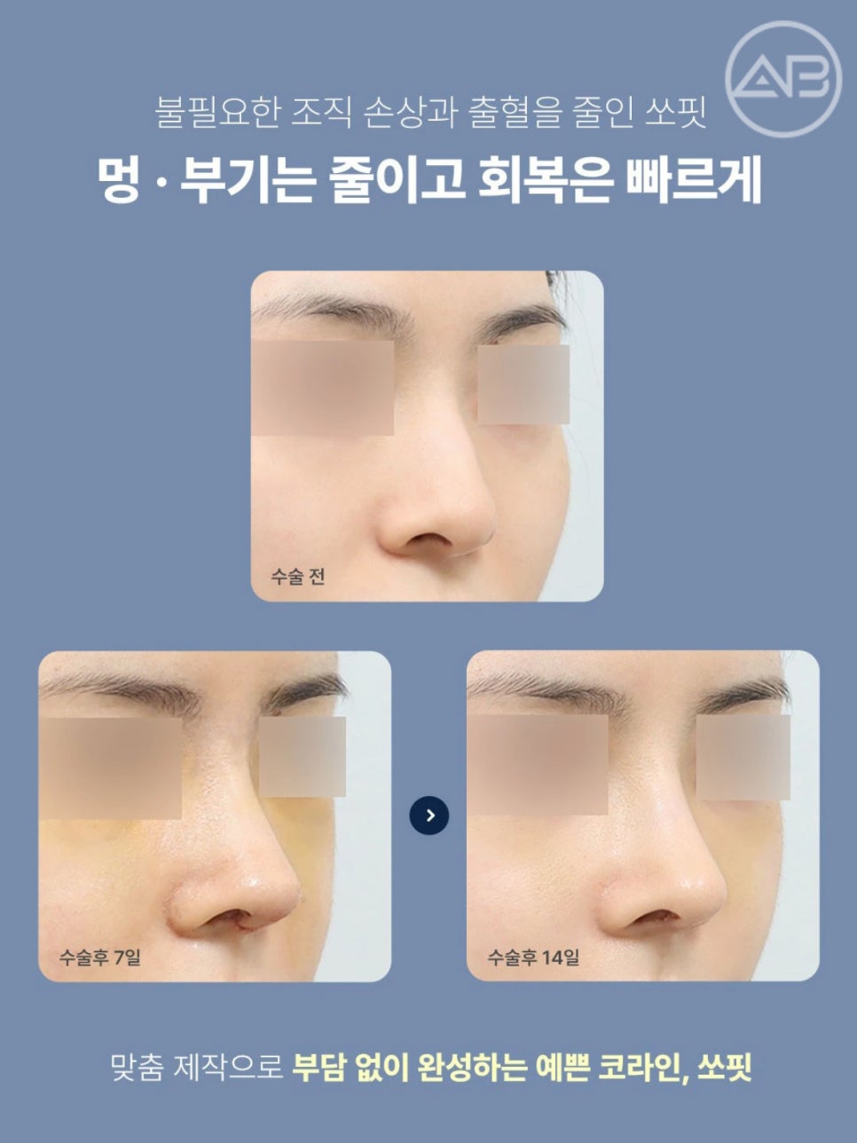 에이비성형외과 맞춤형보형물 쏘핏, 재수술 코의 비대칭과 변형까지 고려해 제작될까? 관련 이미지 2