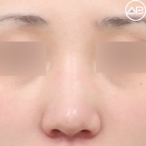 AB Plastic Surgery Low Nose Rhinoplasty Case Review (Feat. Director Seo Chan-eol) image 1