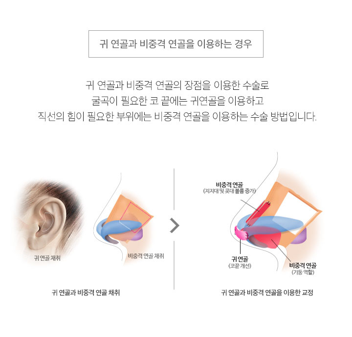 무보형물코수술잘하는곳 에이비성형외과는 어때? 관련 이미지 5