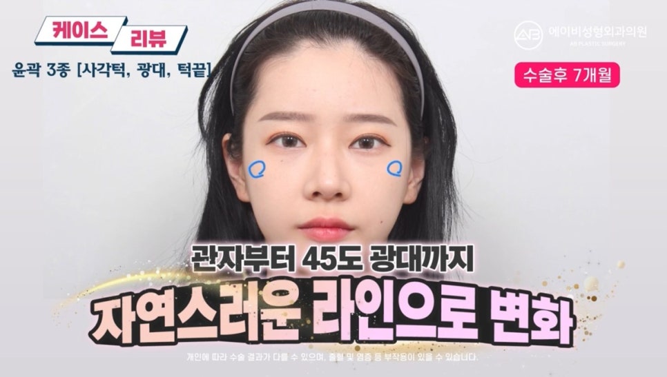 #에이비성형외과#에이비tv#케이스리뷰#윤곽3종수술 관련 이미지 4