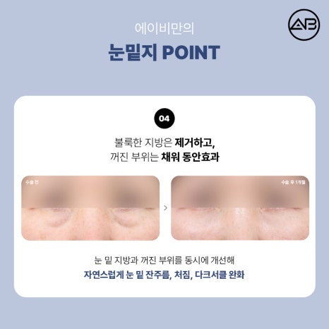에이비성형외과의원 눈밑지방재배치 눈밑지 수술 방법 후기 관련 이미지 8