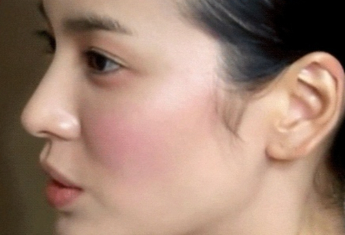 Q. I don’t have much of a nasal bridge, but I want to have only the tip of my nose operated on without an implant. Is that possible? If I have surgery without an implant, how is it performed? image 1