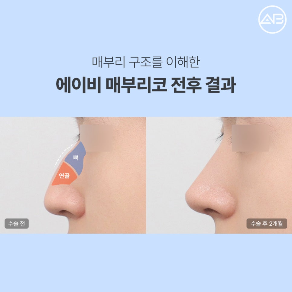 에이비성형외과 매부리코재수술 코절골술이 필요한 경우와 교정 원리 관련 이미지 2