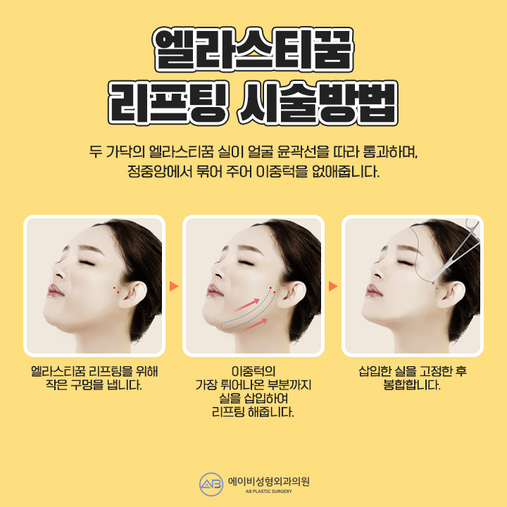 이중턱지방흡입 엘라스티꿈리프팅이 만난다면 관련 이미지 4