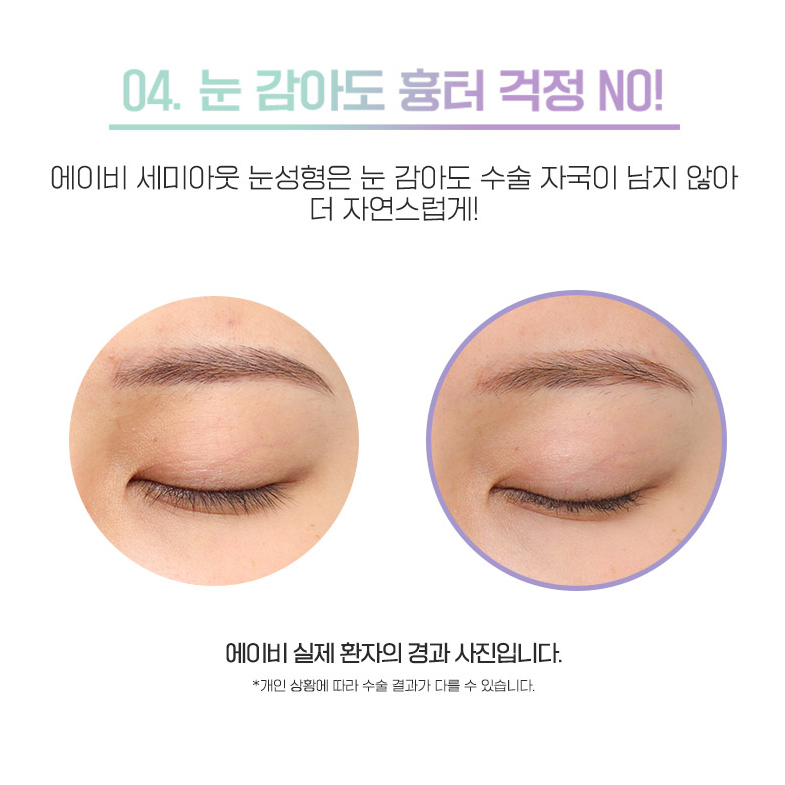 세미아웃눈성형 차이가 있어 관련 이미지 5