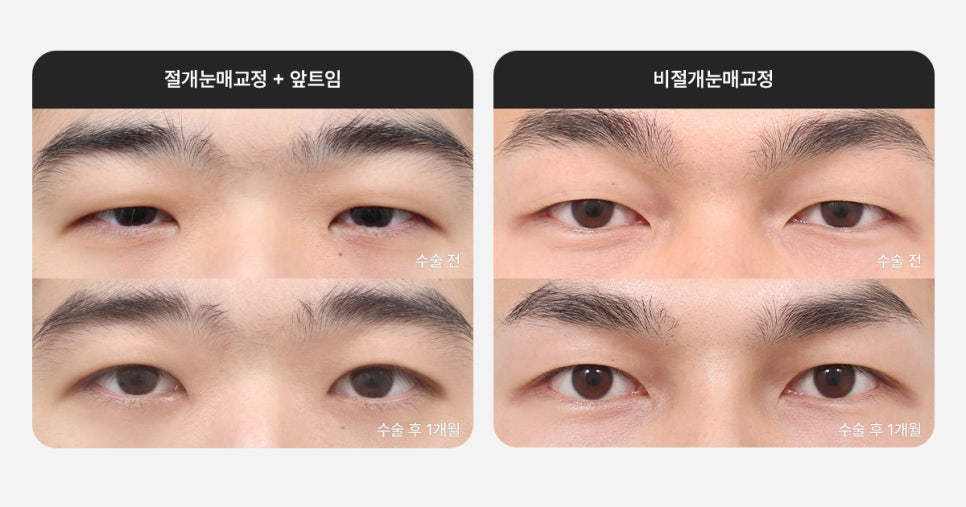 Key Points of Male Eye Surgery, Explained by AB! (Feat. Director Son Ji-hwan) image 2