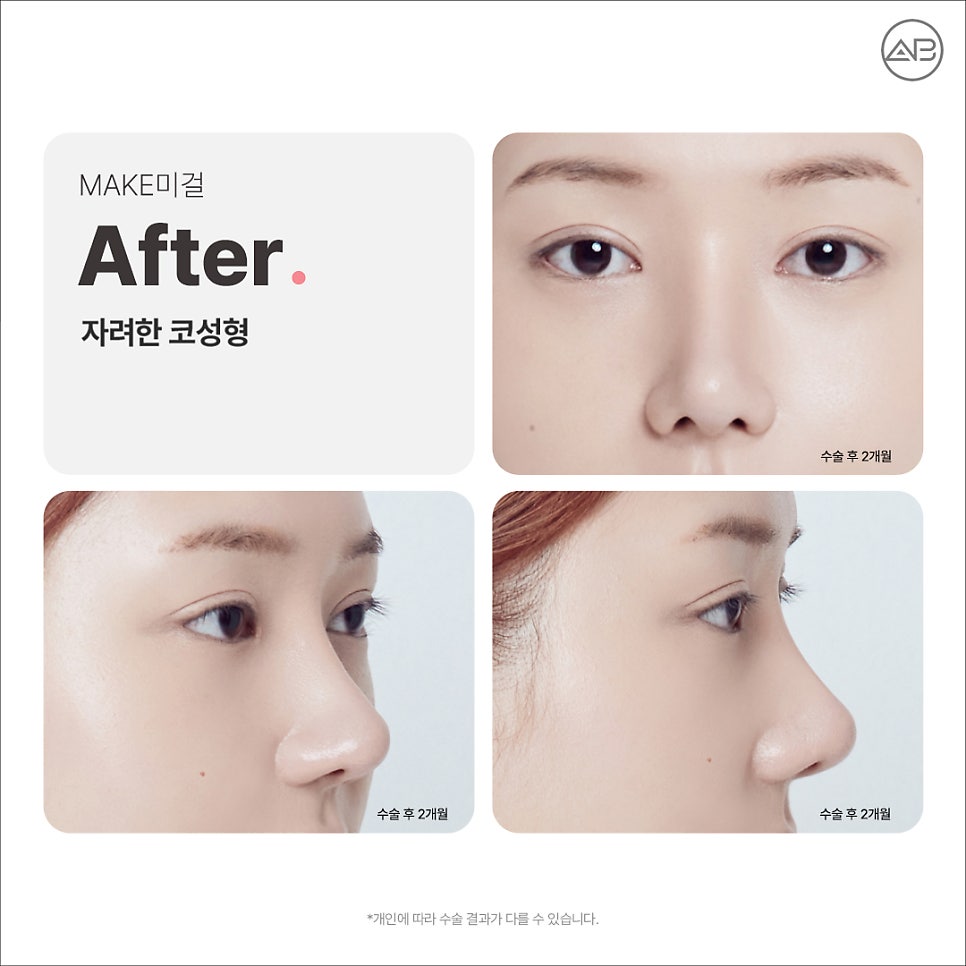 AB Plastic Surgery Make Me Girl (MAKEMEGirl) Episode 8: Makemidol Nose Surgery Review image 4