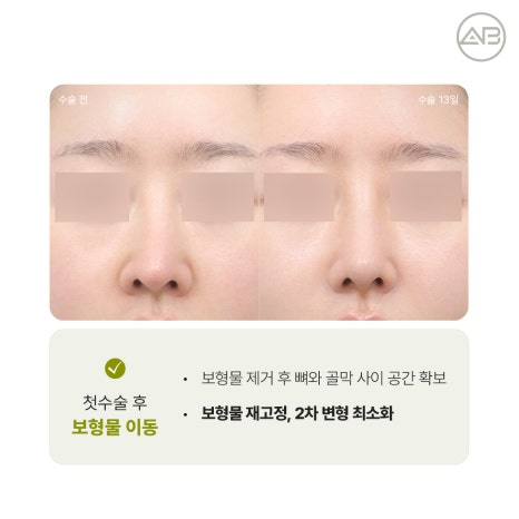에이비성형외과 자가늑연골 비주라인 코재수술 시기와 교정 체크포인트 관련 이미지 9