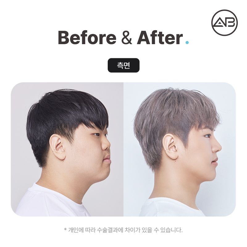 AB Plastic Surgery on MAKE미남 Episode 7 - Looking into the Short Nose Surgery for Gaseum Aen I Nae Namja! image 6
