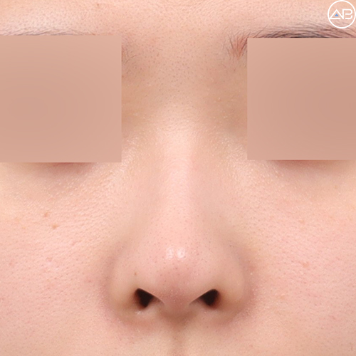 뭉툭한 복코성형, 에이비성형외과 케이스리뷰 관련 이미지 1