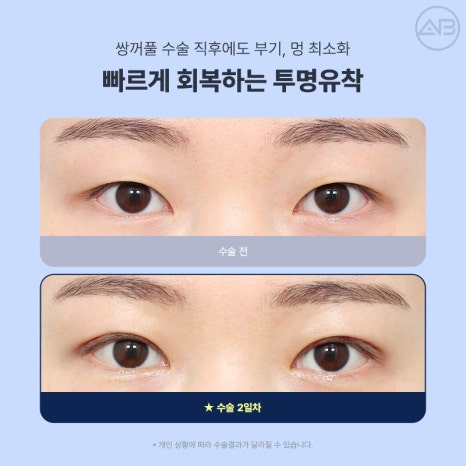 Transparent Adhesion for a Refined Look: AB Plastic Surgery for Attractive Eyes image 6