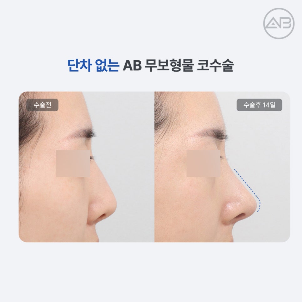 AB Plastic Surgery: Understanding Rhinoplasty Side Effects, Including Contracture, in Implant-Free Rhinoplasty image 5