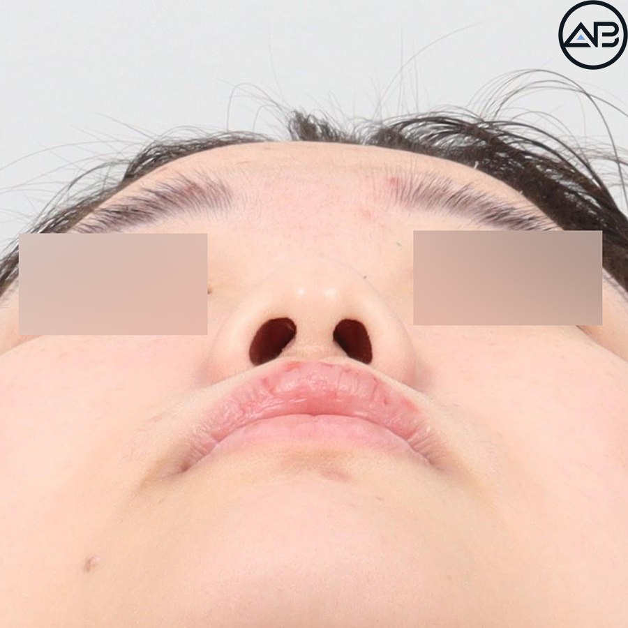 에이비성형외과 자려한코성형 케이스리뷰 관련 이미지 2