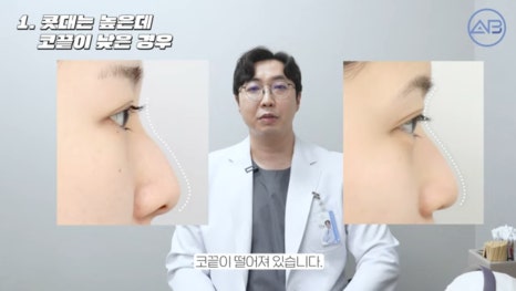 #에이비성형외과#에이비tv#코성형#좋은코성형조건 관련 이미지 3
