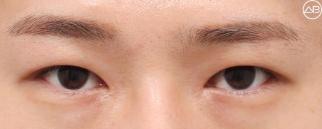 AB Plastic Surgery Male Eye Surgery Case Review (Feat. Director Ahn Moon-young) image 6