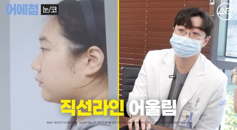에이비성형외과 맥미걸(MAKEMEGirl) 맥미돌 코성형 상담 과정 관련 이미지 32