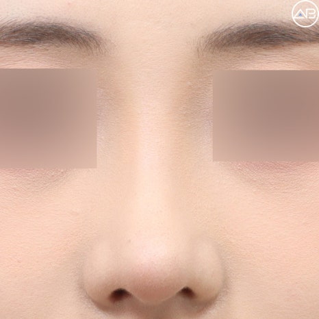 에이비성형외과 자려한코성형 케이스리뷰 (Feat.서찬얼원장) 관련 이미지 3