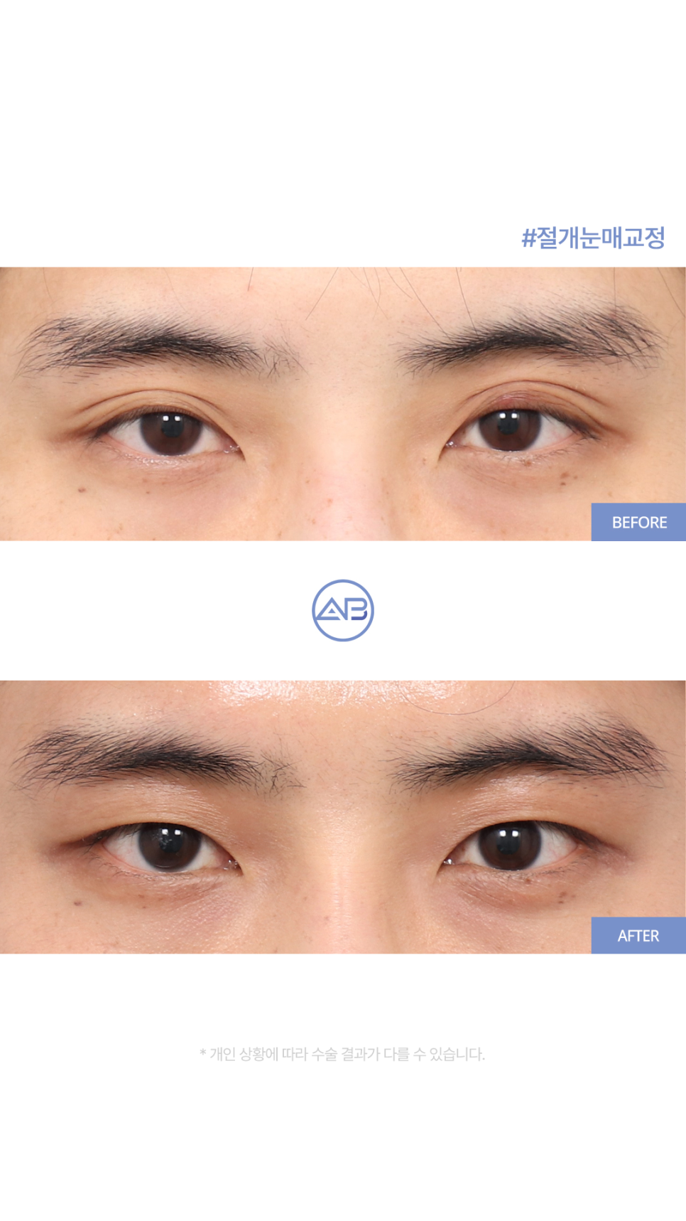 AB성형외과 남자눈매교정 수술전후 관련 이미지 1