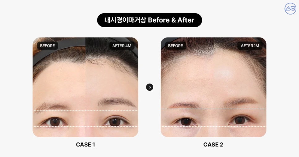 AB Plastic Surgery Endoscopic Forehead Lift: Key to Improving Eye Appearance Before and After Changes! image 3