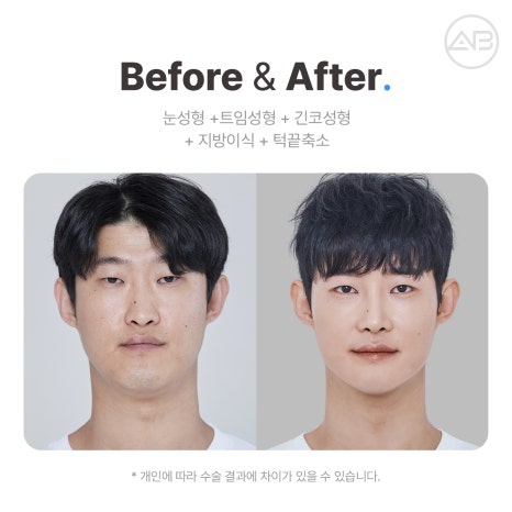 에이비성형외과 맥미남(MAKE미남) 4회 - 도깨비내남자 코수술 알아보기! 관련 이미지 11