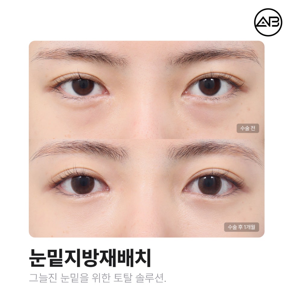 AB Plastic Surgery Under-Eye Fat Repositioning: Effects on Dark Circles and Hollow Under-Eyes, Before-and-After Results, and Side Effects image 1