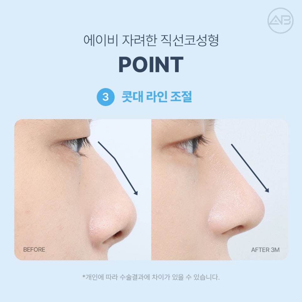AB성형외과 자려한직선코성형 원조는 다르네 관련 이미지 5