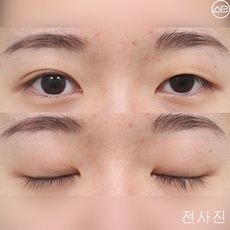 여자 비절개눈매교정 케이스리뷰(Feat.안문영원장) 관련 이미지 1