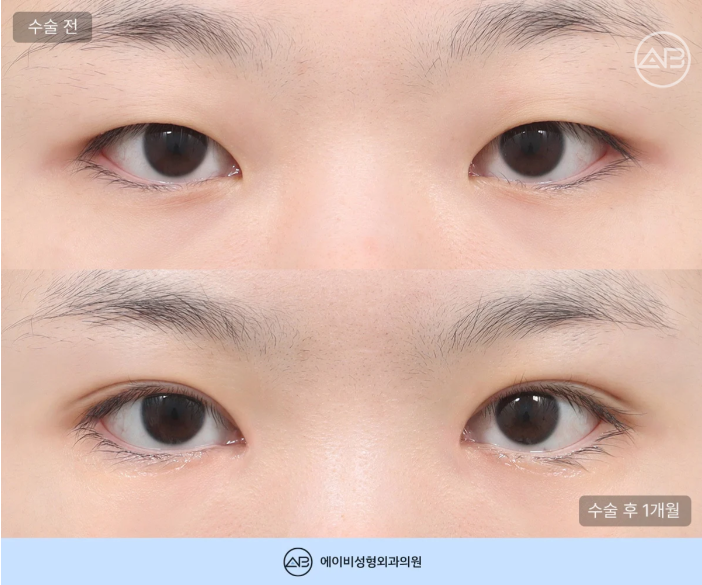 에이비성형외과 무쌍 여자 눈매교정 쌍꺼풀 수술 체크포인트 관련 이미지 4