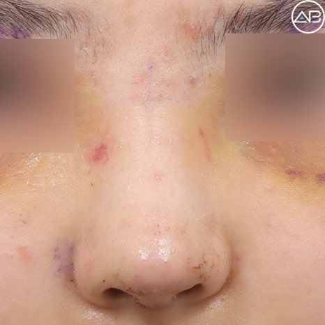 Case Review of Bulbous Nose Surgery That Transformed the Face into a Natural and Refined Look (feat. AB Plastic Surgery) image 3