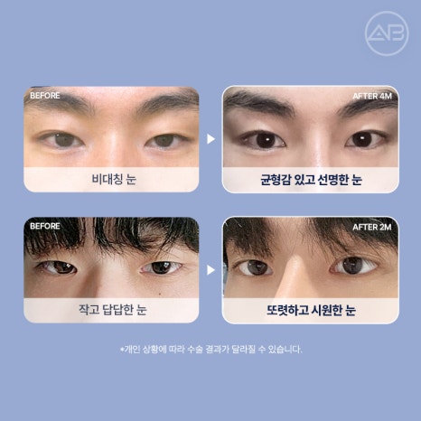 인상을 바꾸는 첫 시작, 에이비성형외과 남자눈성형 관련 이미지 4