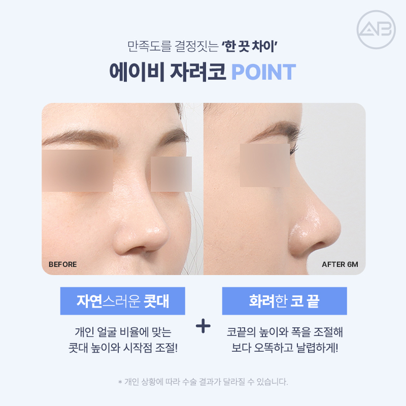 에이비성형외과 자려한코성형이란? 관련 이미지 3